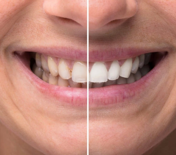 Avant et après bandes blanchissantes V34 GlorySmile