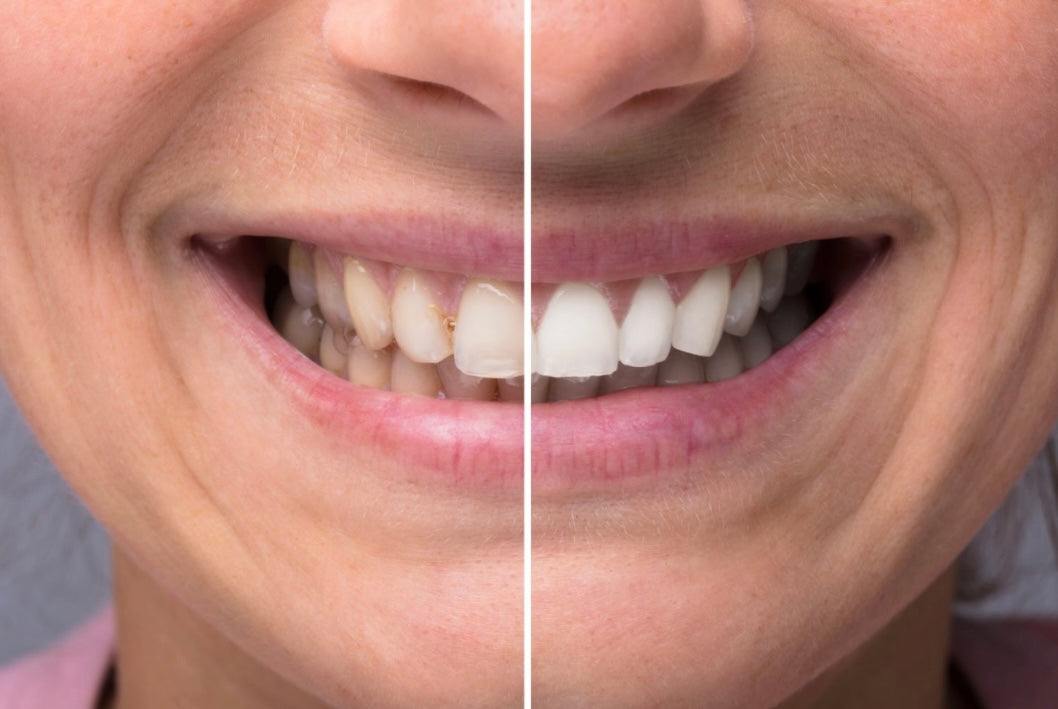 Avant et après bandes blanchissantes V34 GlorySmile